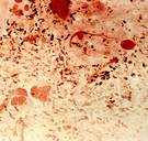 Onbehandelbare gonorroe verspreidt zich over de hele wereld