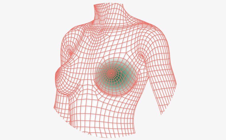 Siliconen uit borstimplantaten zijn mogelijk schadelijk voor cellen - Trouw