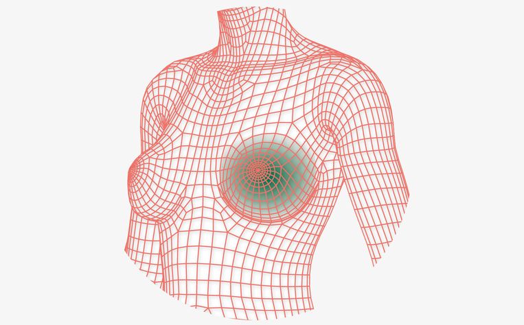 Een Omstreden Implantaat In Je Borst Houden Of Weghalen Trouw