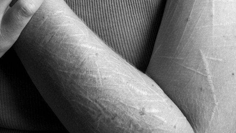 Hoe Help Je Iemand Die Zichzelf Snijdt Trouw