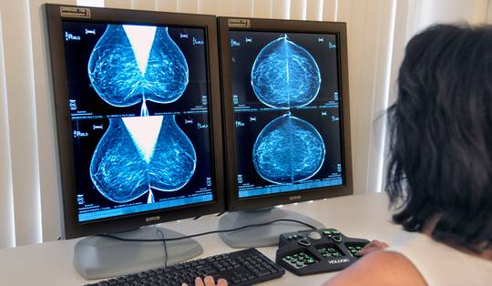 ‘Dit is de toekomst van kankertherapie’: nieuwe test kan vrouwen chemotherapie besparen