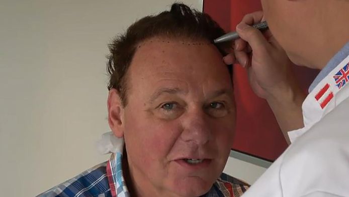 Jan De Hoop Deelt Beelden Haartransplantatie Show Ad Nl