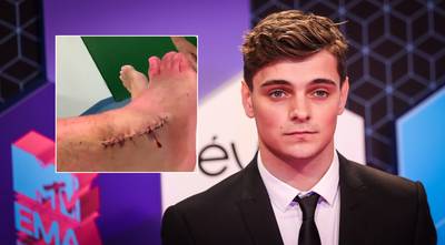 Martin Garrix pareert criticaster over blessure met heftig operatiefilmpje