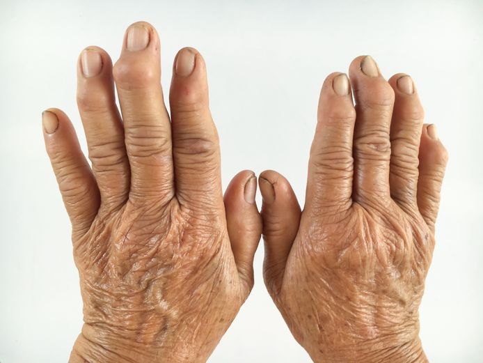 reuma symptomen handen