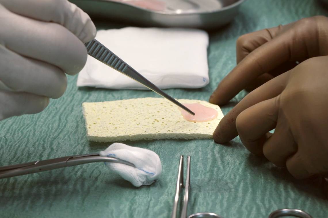 Artsen repareren voor het eerst beschadigd hart met levende pleister, gemaakt uit stamcellen