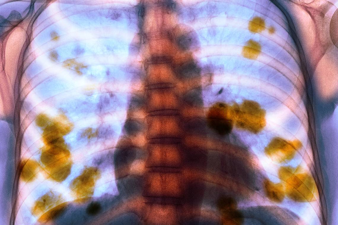 Mogelijk vaccin tegen longkanker in 2030: ‘Grote stap vooruit’